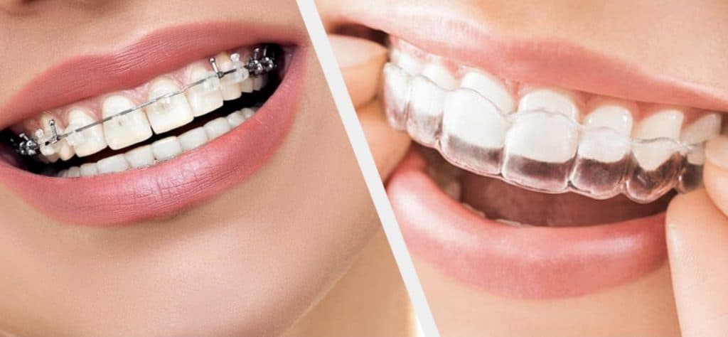 Orthodontic Treatments
