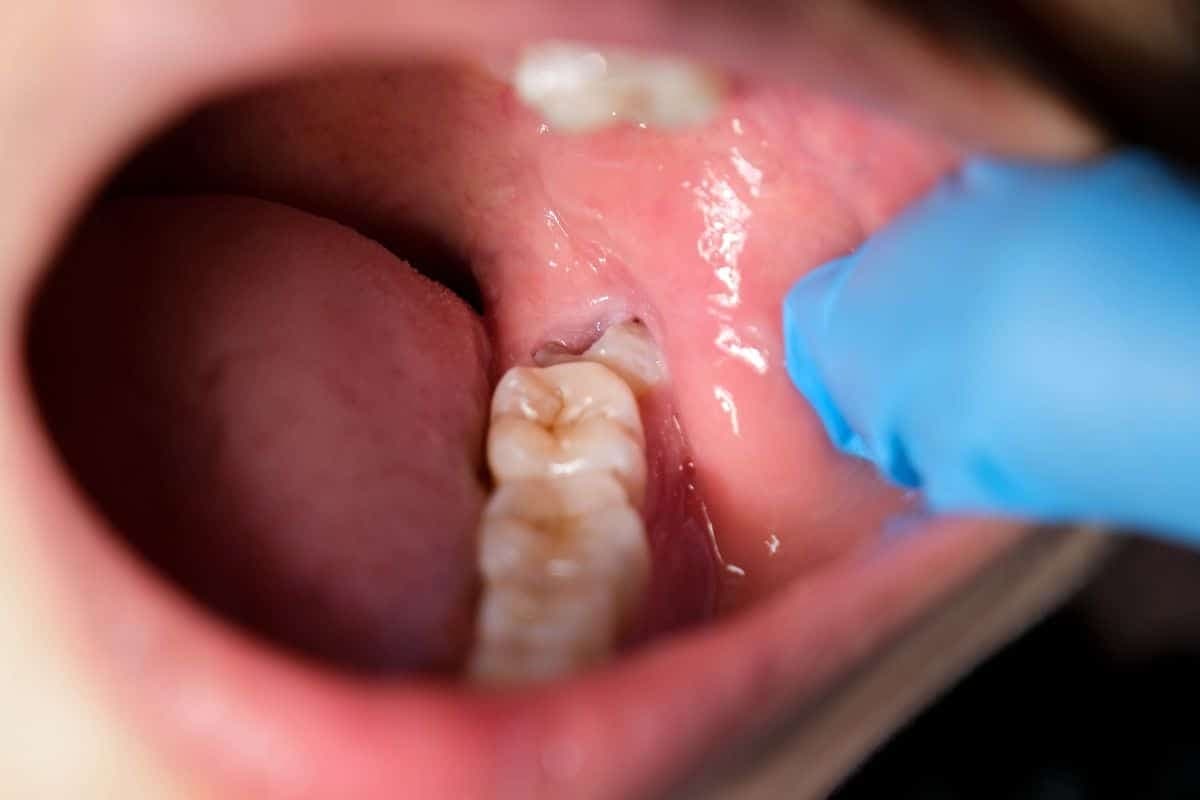 Wisdom Teeth Removal